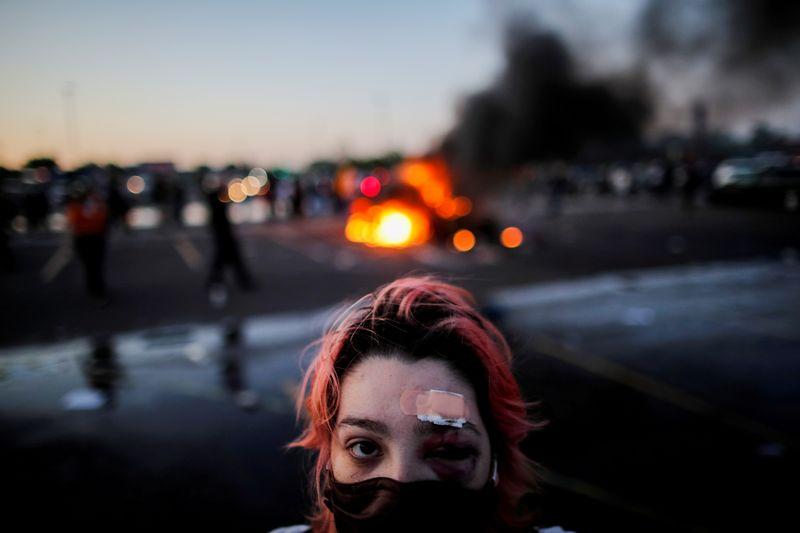 Rachel Perez is pictured with bruising around her eye and a plaster on her forehead, injuries sustained from rubber bullets during protests yesterday, while standing a distance from a burning vehicle at the parking lot of a Target store as demonstrations continue after a white police officer was caught on a bystander's video pressing his knee into the neck of African-American man George Floyd, who later died at a hospital, in Minneapolis, Minnesota, U.S., May 28, 2020. REUTERS/Carlos Barria